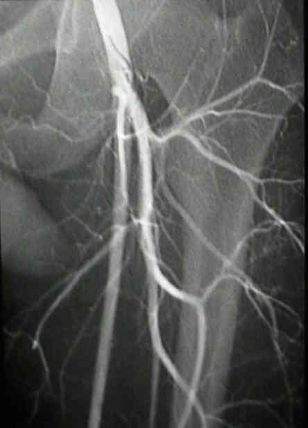 femoral arteryartam1.jpg